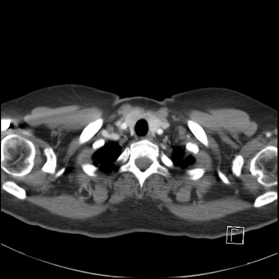 File:Breast metastases from renal cell cancer (Radiopaedia 79220-92225 A 8).jpg