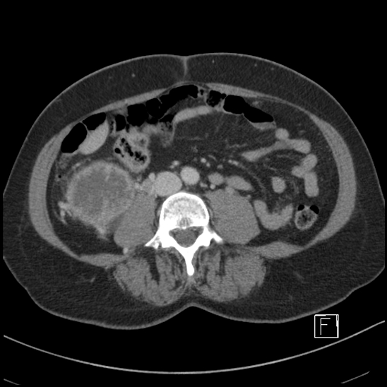 Breast metastases from renal cell cancer (Radiopaedia 79220-92225 C 61).jpg