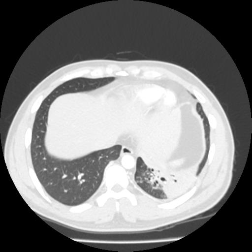 Bronchial carcinoid (Radiopaedia 80013-93291 Axial lung window 101).jpg