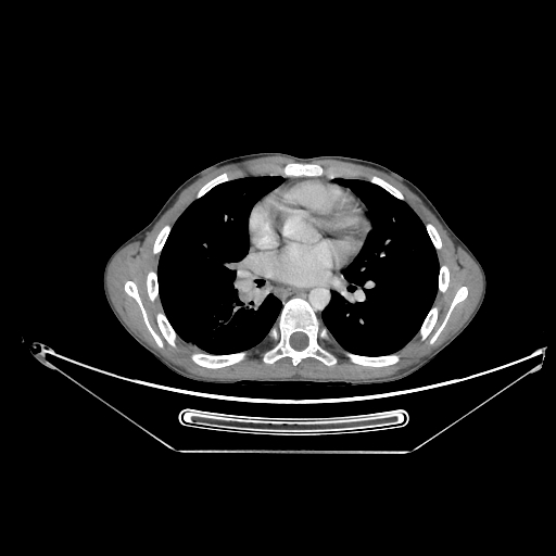 Bronchial carcinoid tumor (Radiopaedia 57187-64090 A 42).jpg