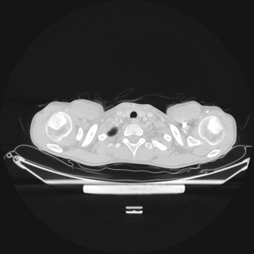 File:Bronchial carcinoid tumor (Radiopaedia 57187-64090 Axial lung window 1).jpg