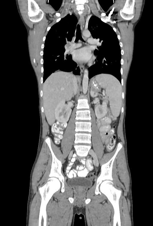 Bronchial carcinoid tumor (Radiopaedia 57187-64090 B 59).jpg