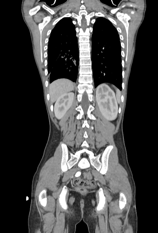 Bronchial carcinoid tumor (Radiopaedia 57187-64090 B 93).jpg