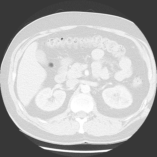 Bronchial carcinoid tumor (Radiopaedia 67377-76764 Axial lung window 70).jpg