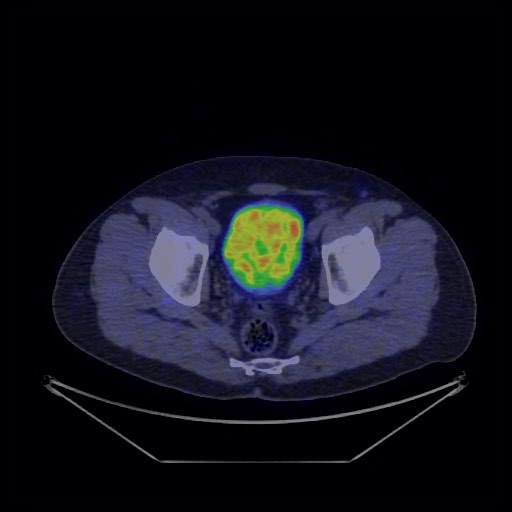 Bronchial carcinoid tumor (Radiopaedia 67377-76765 68Ga-DOTATATE PET-CT 70).jpg