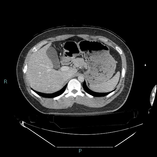 Bronchial carcinoid tumor (Radiopaedia 78272-90870 C 118).jpg