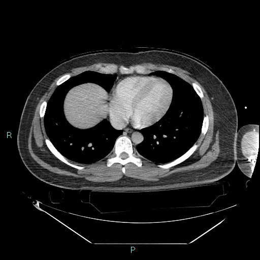 File:Bronchial carcinoid tumor (Radiopaedia 78272-90870 C 83).jpg