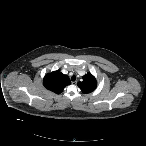 File:Bronchial carcinoid tumor (Radiopaedia 78272-90875 A 22).jpg