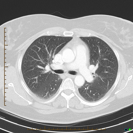 Bronchial diverticula (Radiopaedia 79512-92675 Axial lung window 20).jpg