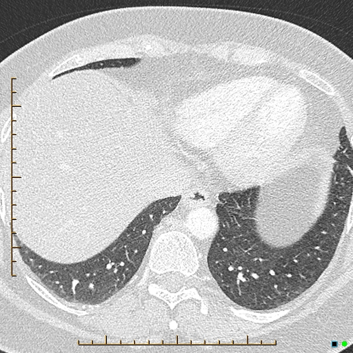 Bronchial diverticula (Radiopaedia 79512-92676 Axial lung window 167).jpg