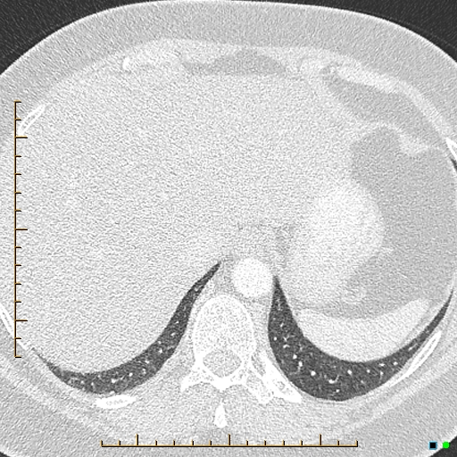 Bronchial diverticula (Radiopaedia 79512-92676 Axial lung window 186).jpg