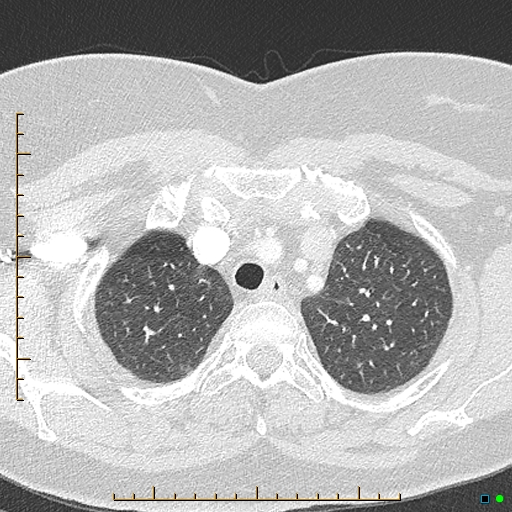 Bronchial diverticula (Radiopaedia 79512-92676 Axial lung window 23).jpg