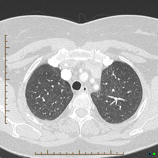 Bronchial diverticula (Radiopaedia 79512-92676 Axial lung window 30).jpg