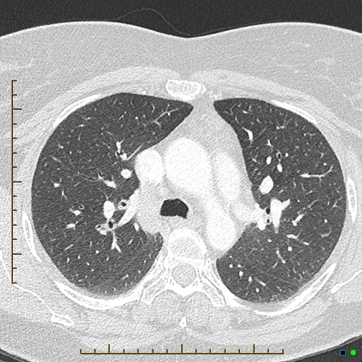 Bronchial diverticula (Radiopaedia 79512-92676 Axial lung window 64).jpg