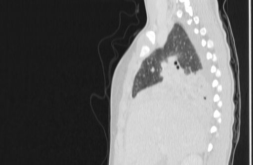 File:Bronchial mucoepidermoid carcinoma (Radiopaedia 57023-63895 Sagittal lung window 42).jpg