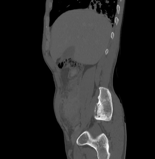 Bronchiectasis in Crohn disease (Radiopaedia 60311-67977 Sagittal bone window 52).jpg