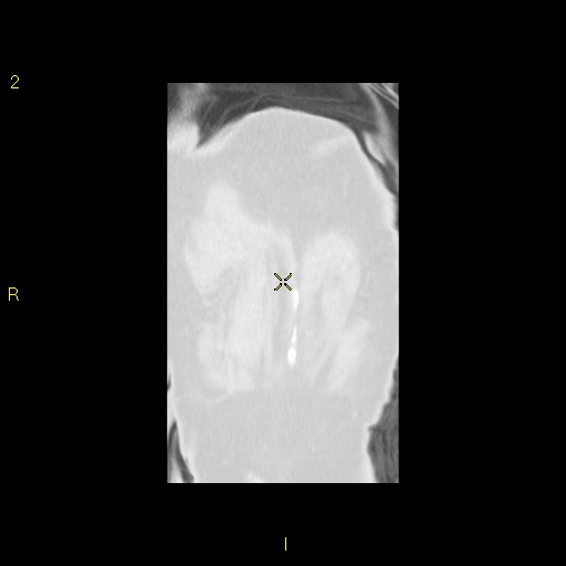 File:Bronchogenic carcinoma as an incidental finding (Radiopaedia 16453-16130 Coronal lung window 46).jpg