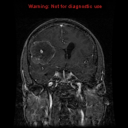 File:Bronchogenic carcinoma brain metastasis (Radiopaedia 9286-9969 Coronal T1 21).jpg