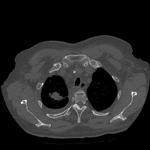 Bronchogenic carcinoma with metastatic lymphadenopathy (Radiopaedia 37671-39569 Axial bone window 11).jpg