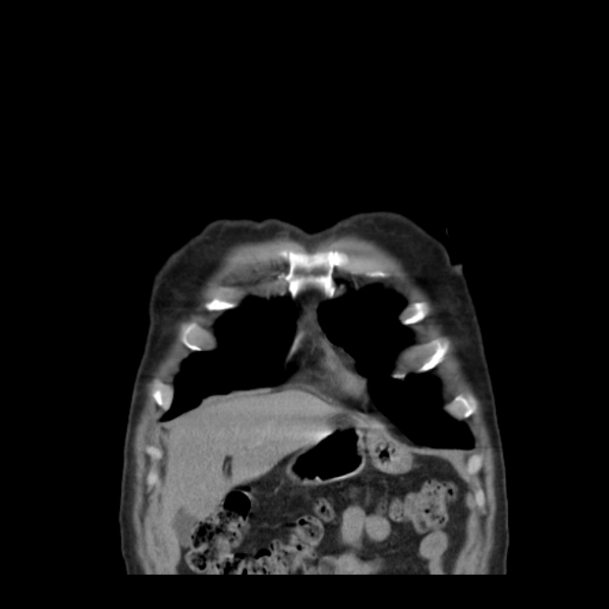 Bronchogenic carcinoma with upper lobe collapse (Radiopaedia 29297-29726 D 10).jpg