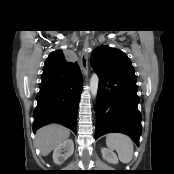 Bronchogenic carcinoma with upper lobe collapse (Radiopaedia 29297-29726 D 39).jpg