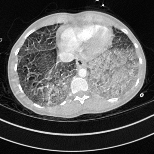 Bronchogenic cyst (Radiopaedia 77801-90071 Axial lung window 68).jpg