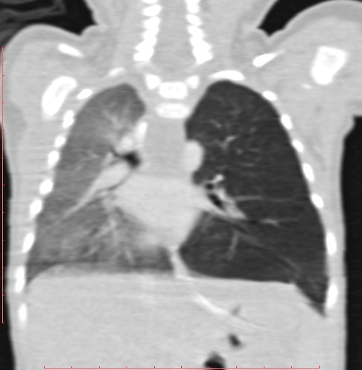 Bronchogenic cyst (Radiopaedia 78599-91409 Coronal lung window 136).jpg