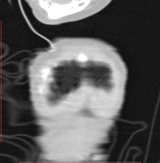 Bronchogenic cyst (Radiopaedia 78599-91409 Coronal lung window 8).jpg