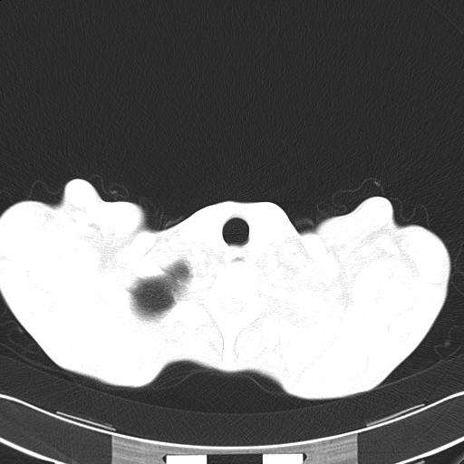 Bronchopleural fistula secondary to tuberculosis (Radiopaedia 20415-20322 Axial lung window 6).jpg