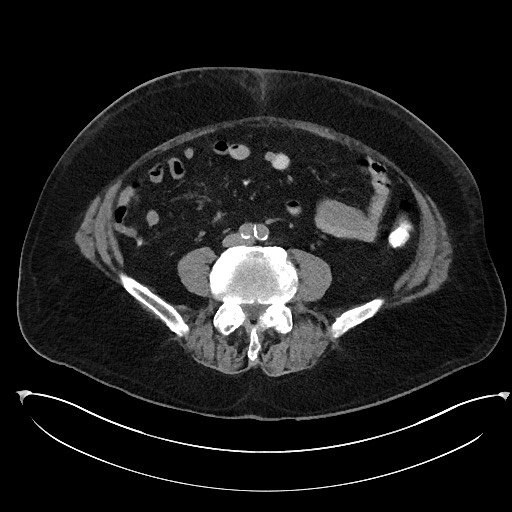 Buried bumper syndrome - gastrostomy tube (Radiopaedia 63843-72577 Axial Inject 75).jpg