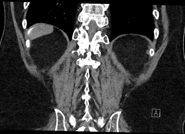 File:Buried bumper syndrome - gastrostomy tube (Radiopaedia 63843-72577 Coronal Inject 116).jpg
