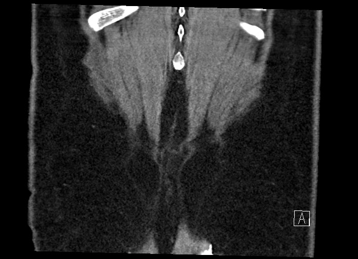 Buried bumper syndrome - gastrostomy tube (Radiopaedia 63843-72577 Coronal Inject 134).jpg