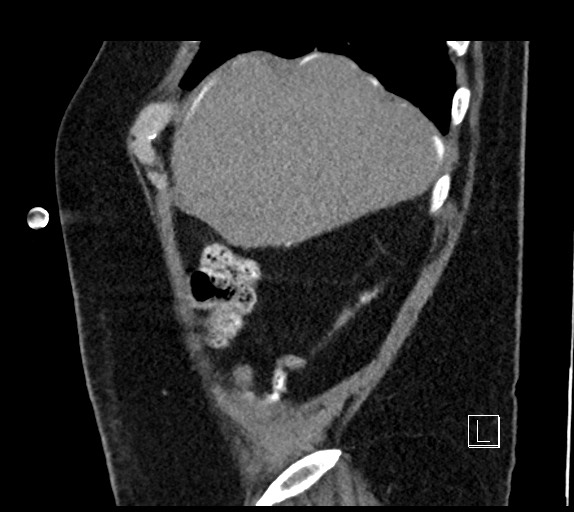 Buried bumper syndrome - gastrostomy tube (Radiopaedia 63843-72577 Sagittal Inject 104).jpg
