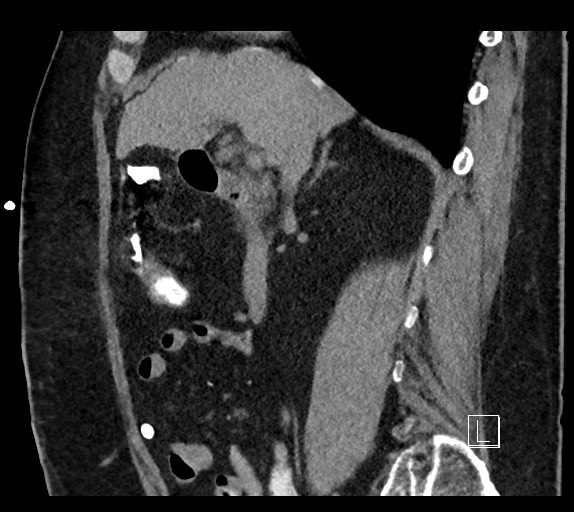 Buried bumper syndrome - gastrostomy tube (Radiopaedia 63843-72577 Sagittal Inject 75).jpg