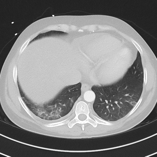 Burkitt lymphoma (Radiopaedia 34686-36121 Axial lung window 37).png