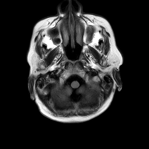 File:Burnt-out meningioma (Radiopaedia 51557-57336 Axial 3).jpg