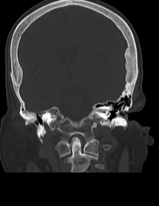 Burnt-out meningioma (Radiopaedia 51557-57337 Coronal bone window 28).jpg