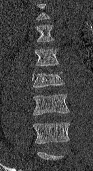 Burst fracture (Radiopaedia 53373-59357 Coronal bone window 15).jpg