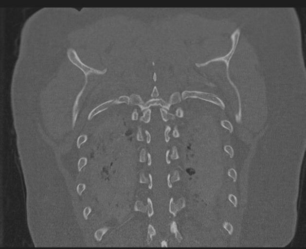 Burst fracture - thoracic spine (Radiopaedia 30238-30865 Coronal bone window 137).jpg