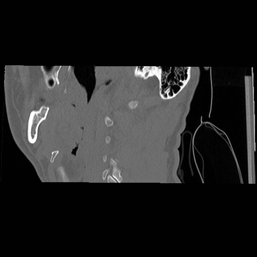 File:C1-C2 "subluxation" - normal cervical anatomy at maximum head rotation (Radiopaedia 42483-45607 C 59).jpg