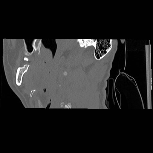 File:C1-C2 "subluxation" - normal cervical anatomy at maximum head rotation (Radiopaedia 42483-45607 C 61).jpg