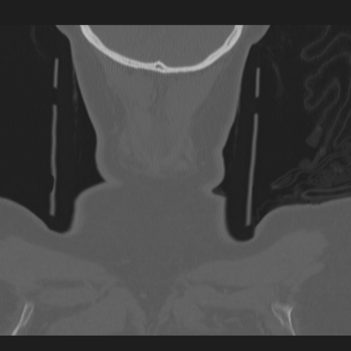 C2 fracture (Radiopaedia 34091-35341 Coronal bone window 64).png
