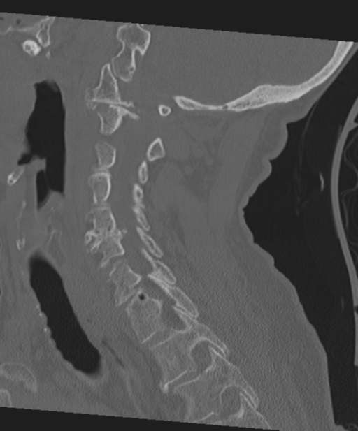 C2 fracture with vertebral artery dissection (Radiopaedia 37378-39199 Sagittal bone window 32).png