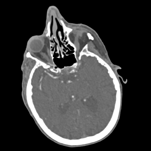 C2 fracture with vertebral artery dissection (Radiopaedia 37378-39200 A 237).png