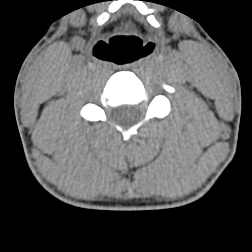 File:C5 facet fracture (Radiopaedia 58374-65499 Axial non-contrast 48).jpg