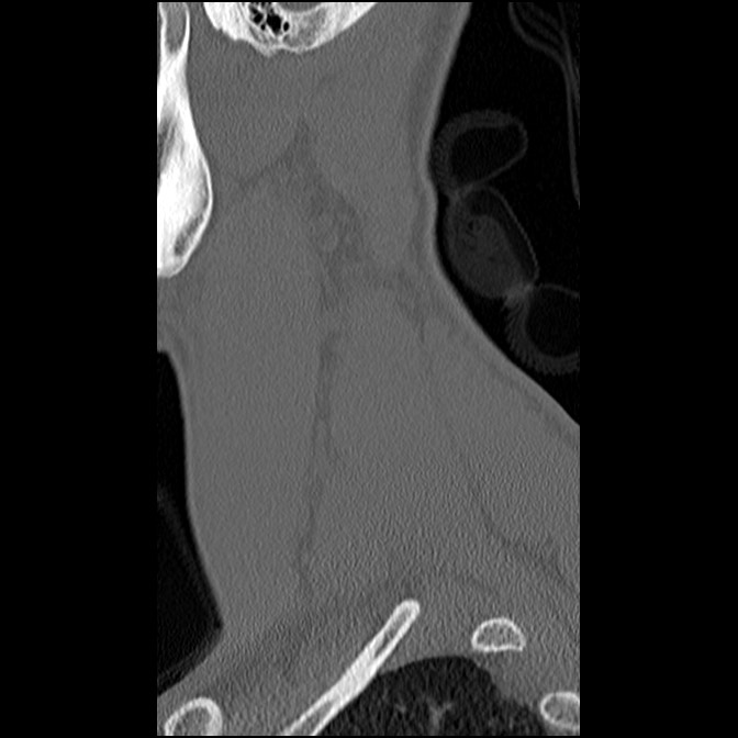 C5 facet fracture (Radiopaedia 58374-65499 Sagittal bone window 62).jpg