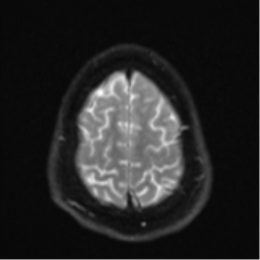 File:CNS vasculitis (Radiopaedia 55715-62263 Axial DWI 26).png