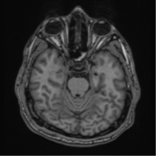 CNS vasculitis (Radiopaedia 55715-62263 Axial T1 2).png