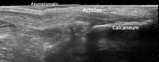 File:Calcaneal tuberosity avulsion fracture - ultrasound (Radiopaedia 29978-30524 E 1).jpg