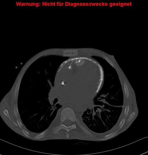 File:Calcific constrictive pericarditis (Radiopaedia 24701-24967 Axial bone window 12).jpg
